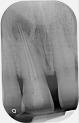 Open apex management - Pre-op Case 2